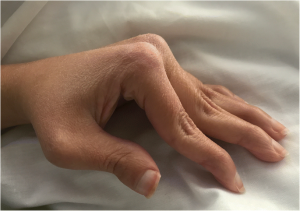 Артрит (arthritis)