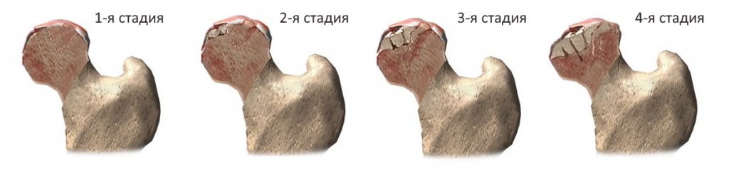 Асептический (аваскулярный) некроз