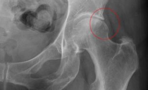 Фемороацетабулярный импинджмент синдром (FAI)