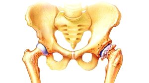 Коксит (coxitis) coxarthritis
