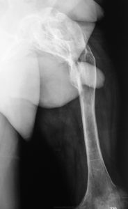 Миозит (myositis)