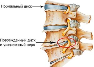 Остеохондроз (osteochondrosis)