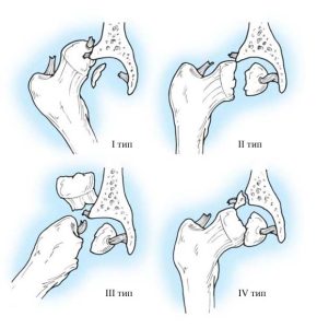 Центральный переломо-вывих бедра