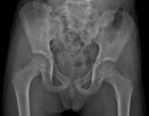 Ревматоидный артрит