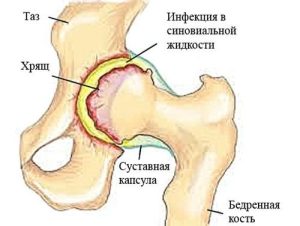 Синовит (Synovitis)