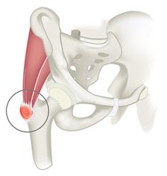 Трохантерит