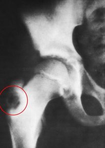 Туберкулезный коксит