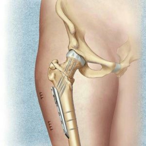 Fractura coxae