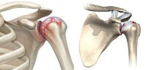 артрит плечевого сустава 