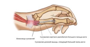 Болезнь де Кервена (стенозирующий лигаментит)